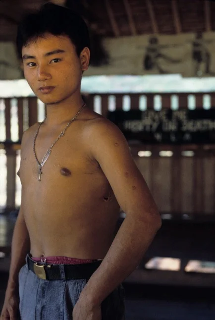Teenage soldier with gunshot wound under arm, Manerplaw, Burma