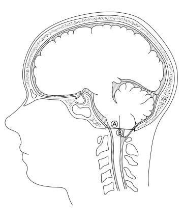 Measuring tonsillar herniation