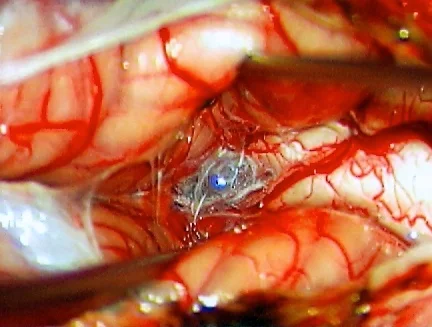Image from the Editor's files shows the median aperture of the 4th ventricle, also known as the foramen of Magendie, covered by a veil in this person with Chiari & syringomyelia. Image: CyberMed, LLC