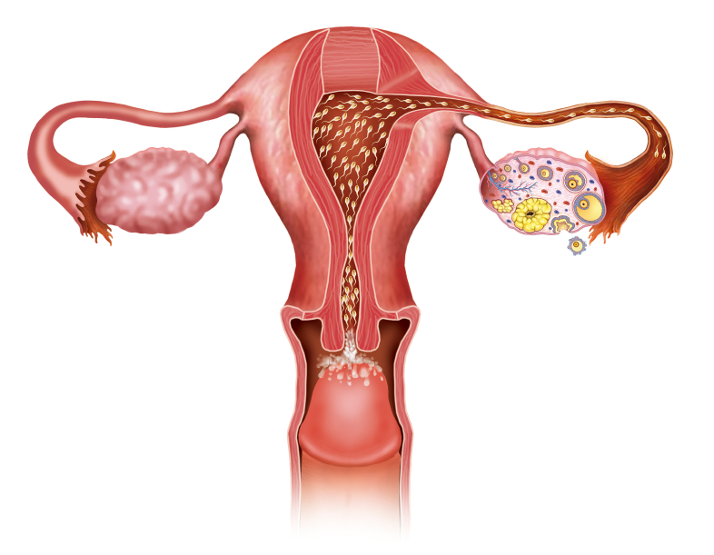 Uterus pregnancy complications retroverted Tilted Uterus: