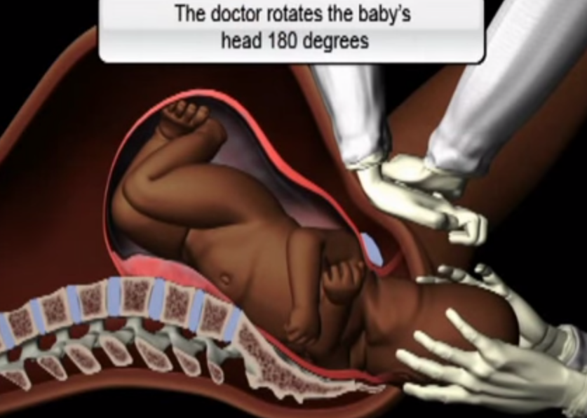 Newborn Birth Injuries: The Untold Story