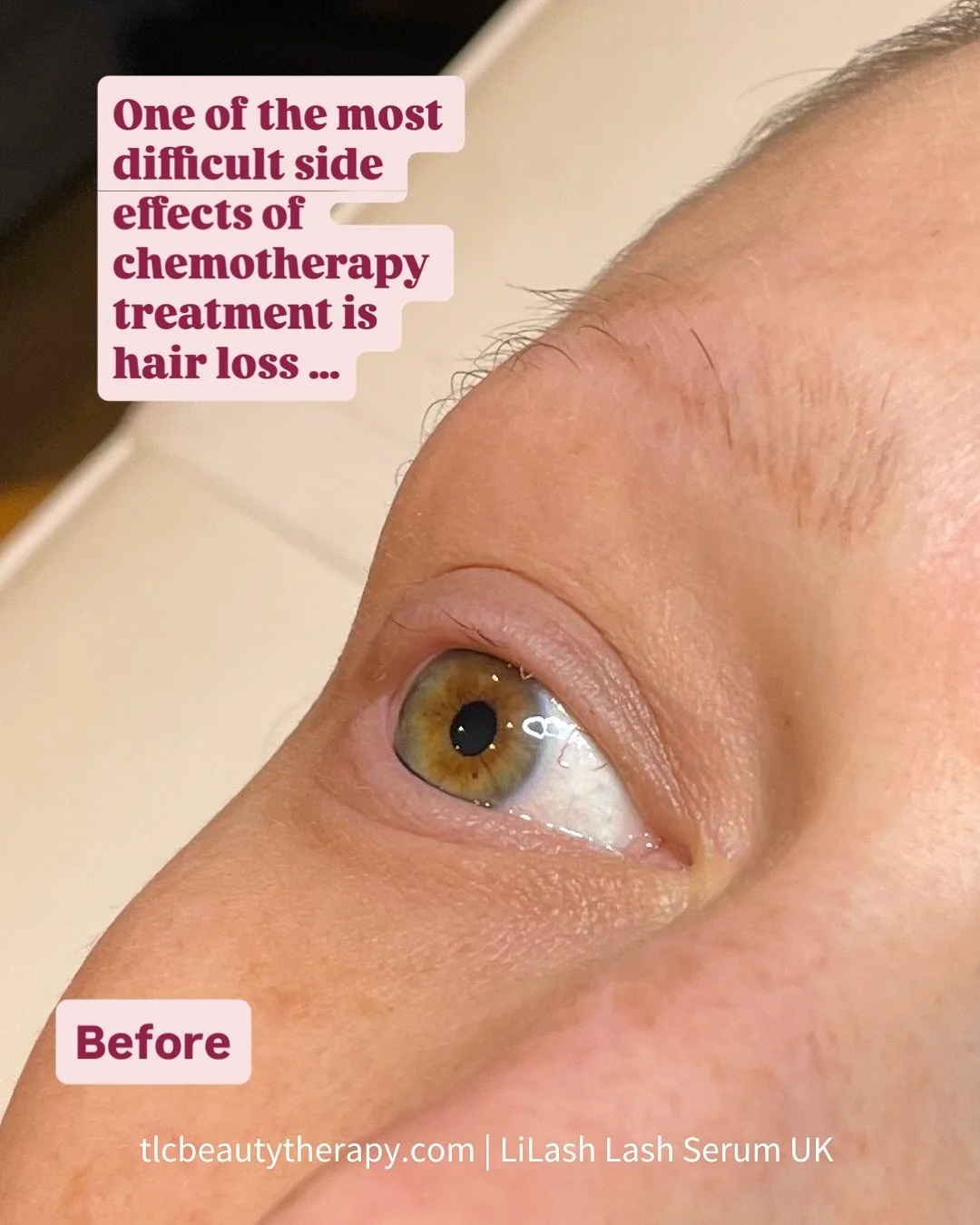 Losing your eyelashes, eyebrows, and other body hair can be one of the most difficult side effects of chemotherapy - having a real impact on your confidence. 

It can take many months, sometimes a year, for your lashes and brows to grow back fully.

