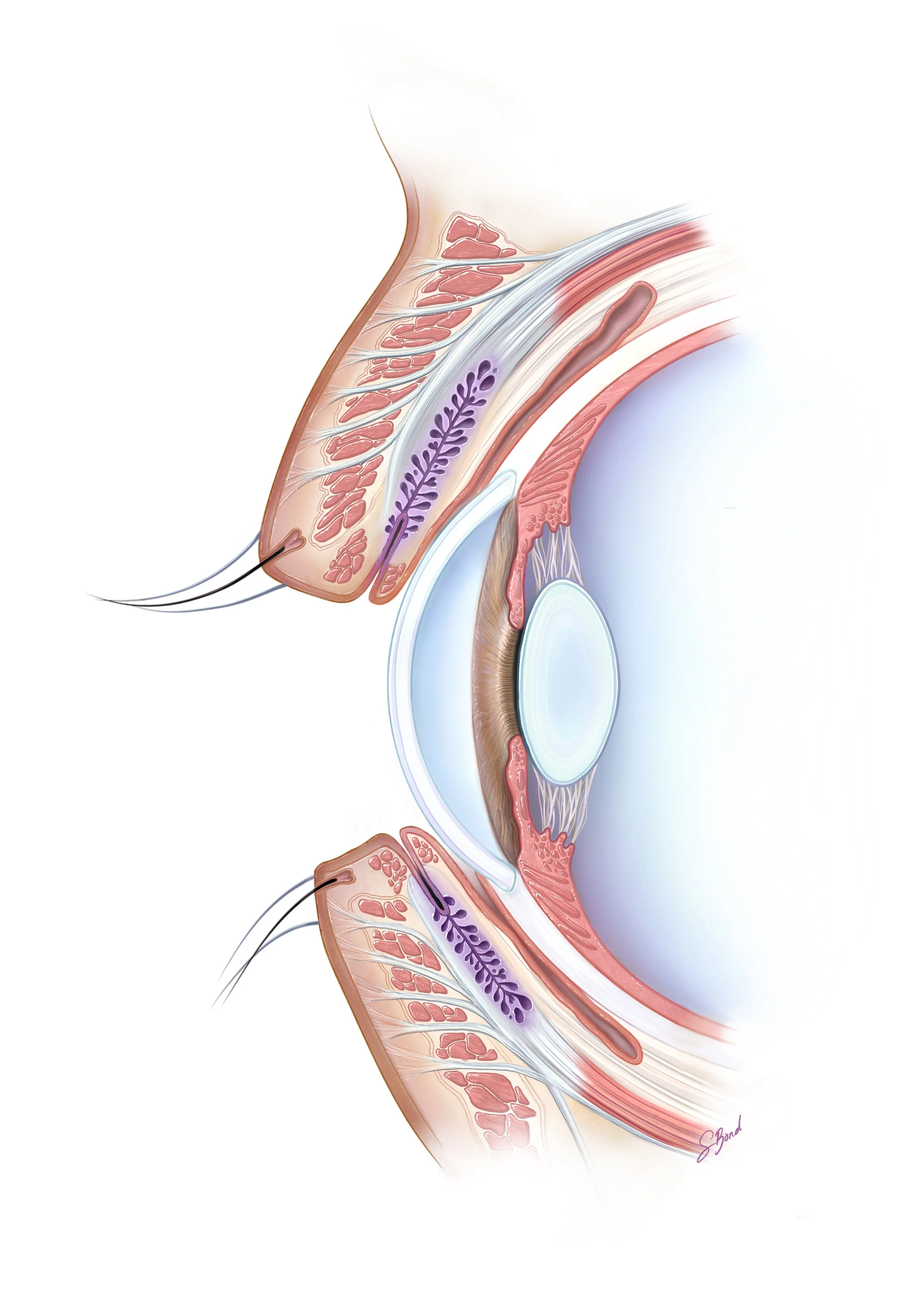 Anatomy of the Meibomian Gland (Sagittal)