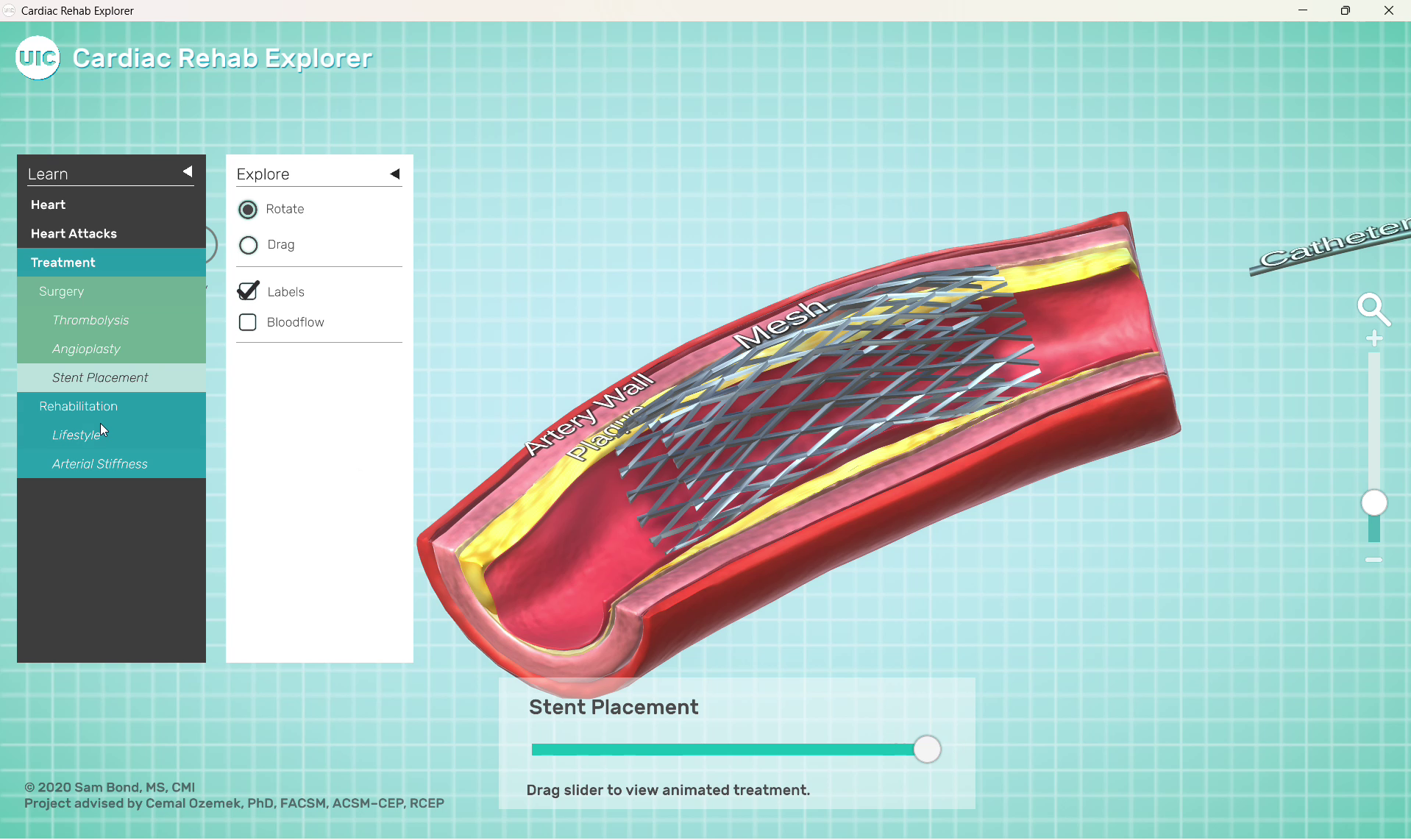 cardiac-rehab-explorer-04-stent-placement.png
