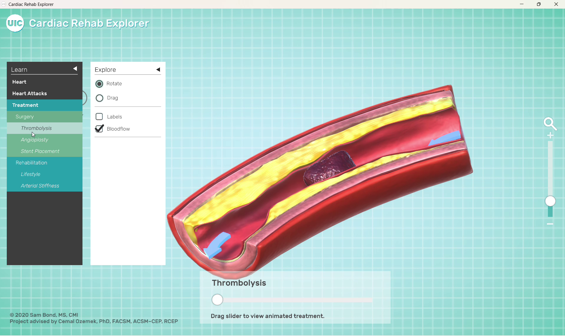cardiac-rehab-explorer-07-thrombolysis-before-treatment.png