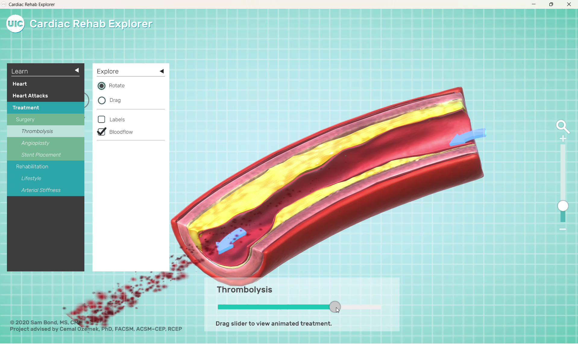 cardiac-rehab-explorer-09-thrombolysis-clot-cleared.png