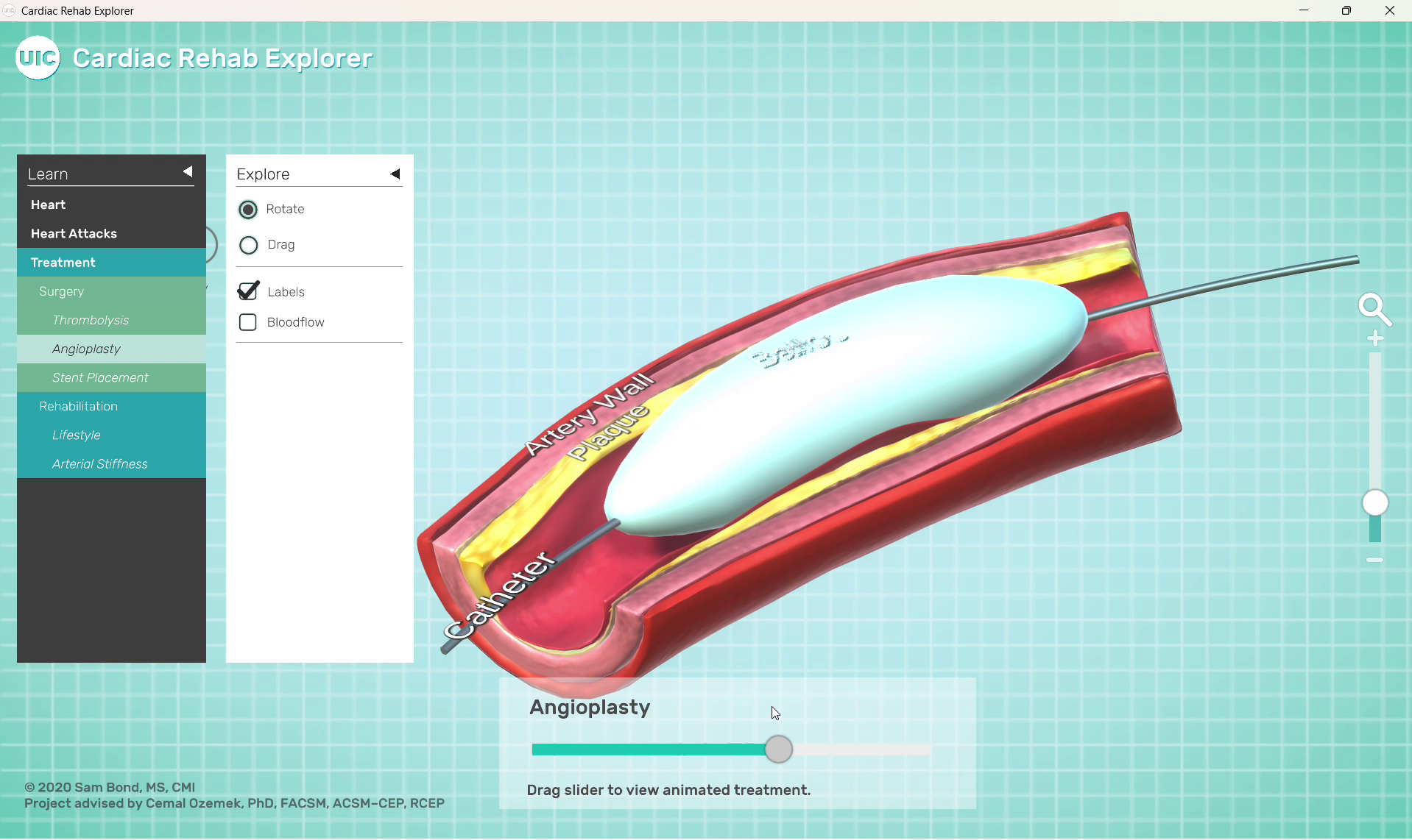 cardiac-rehab-explorer-10-balloon-angioplasty.png