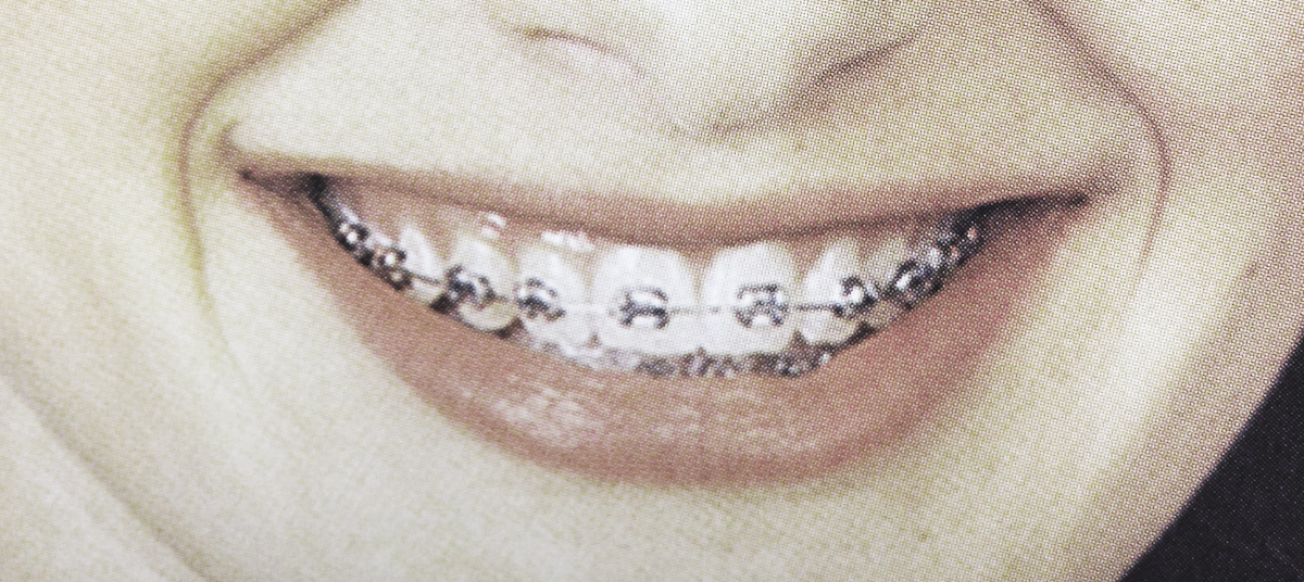 Silver Braces