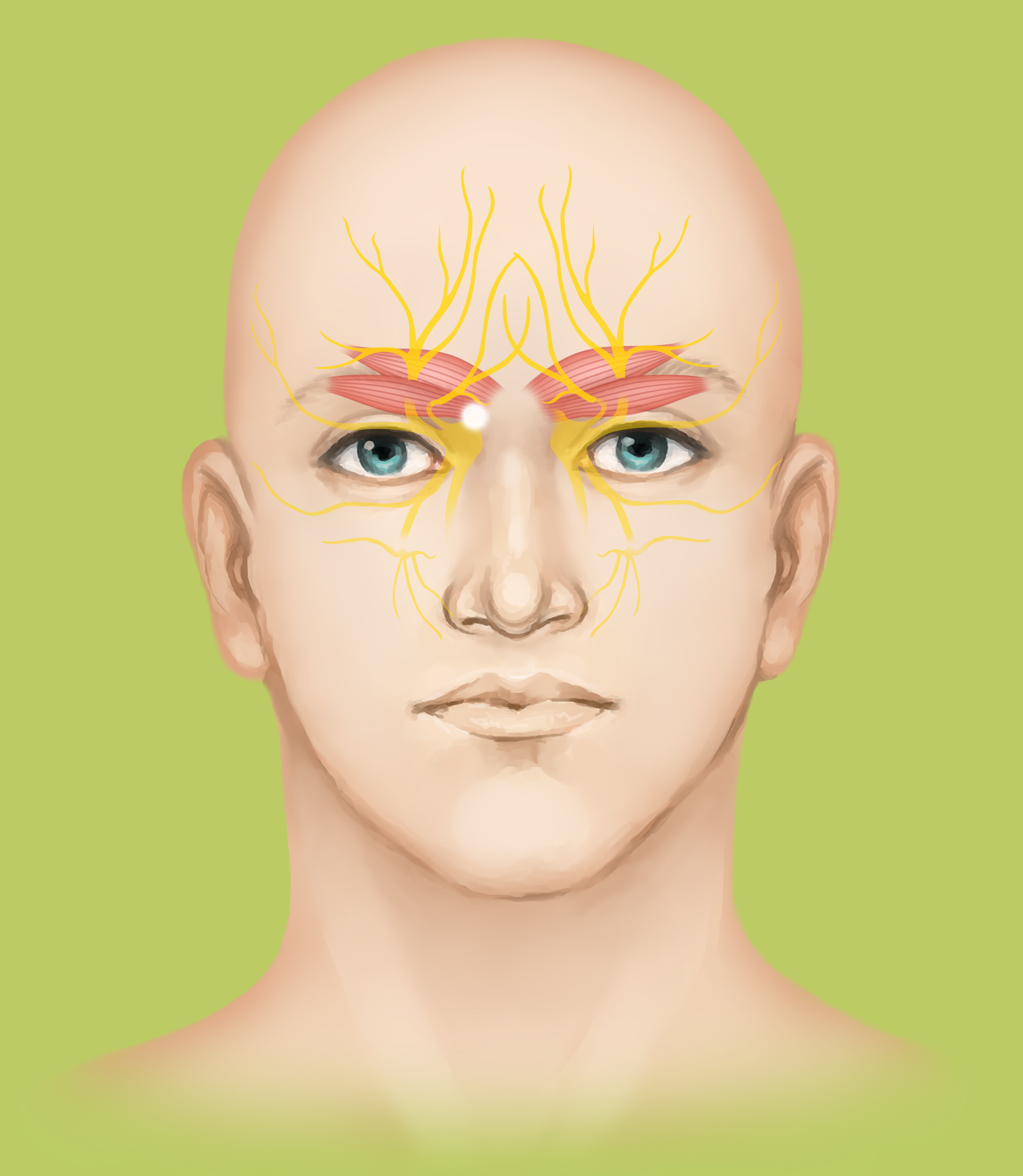 Trigger Point Release And Nerve Decompression For Migraines And Chronic