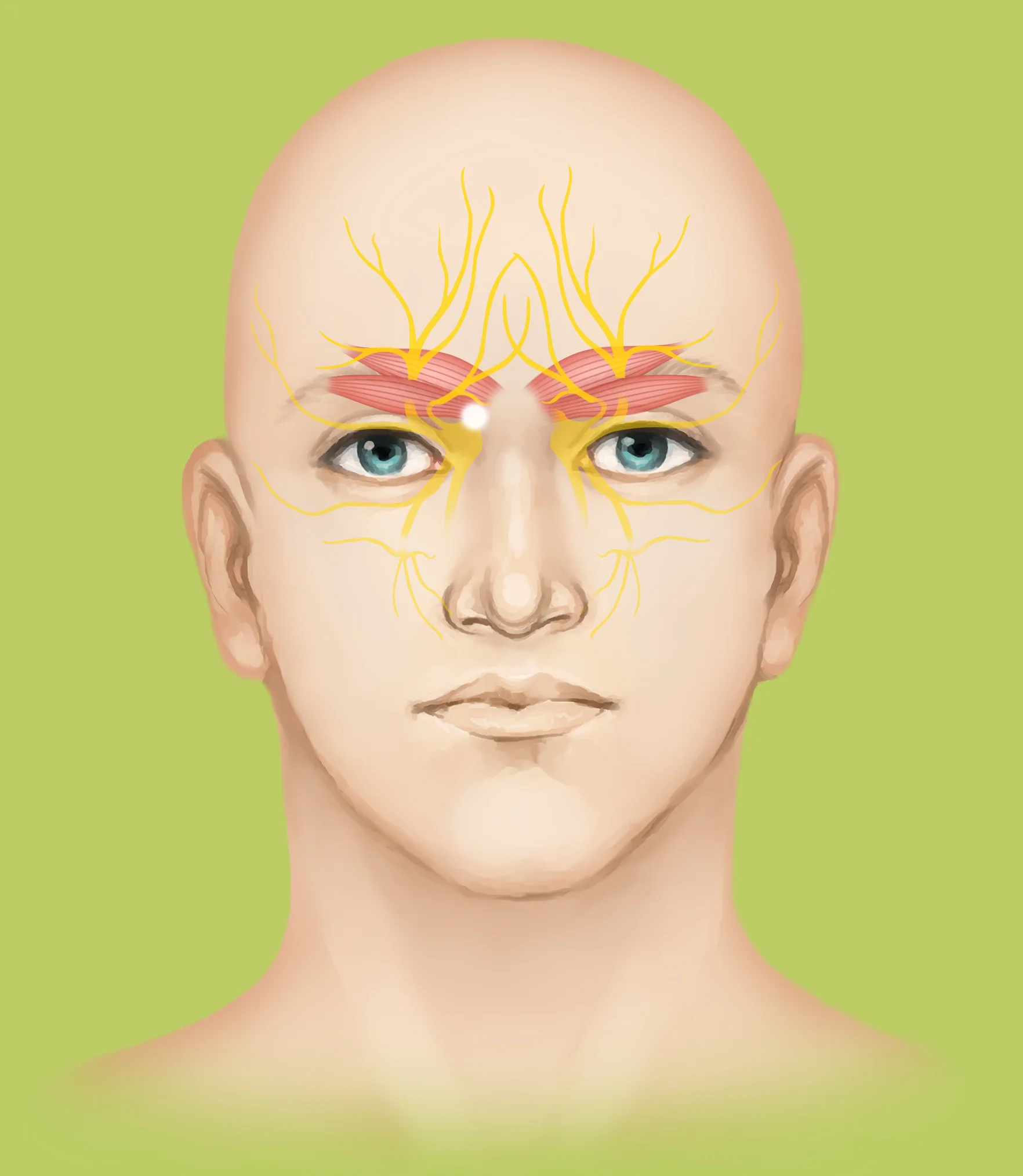 Supraorbital and supratrochlear nerves are decompressed.