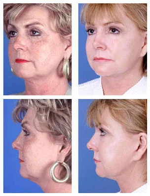 facelift-3338.jpeg