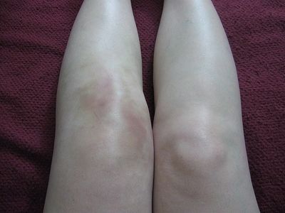 article-new_ehow_images_a05_6j_c7_living-arthritic-knee-pain-800x800.jpg