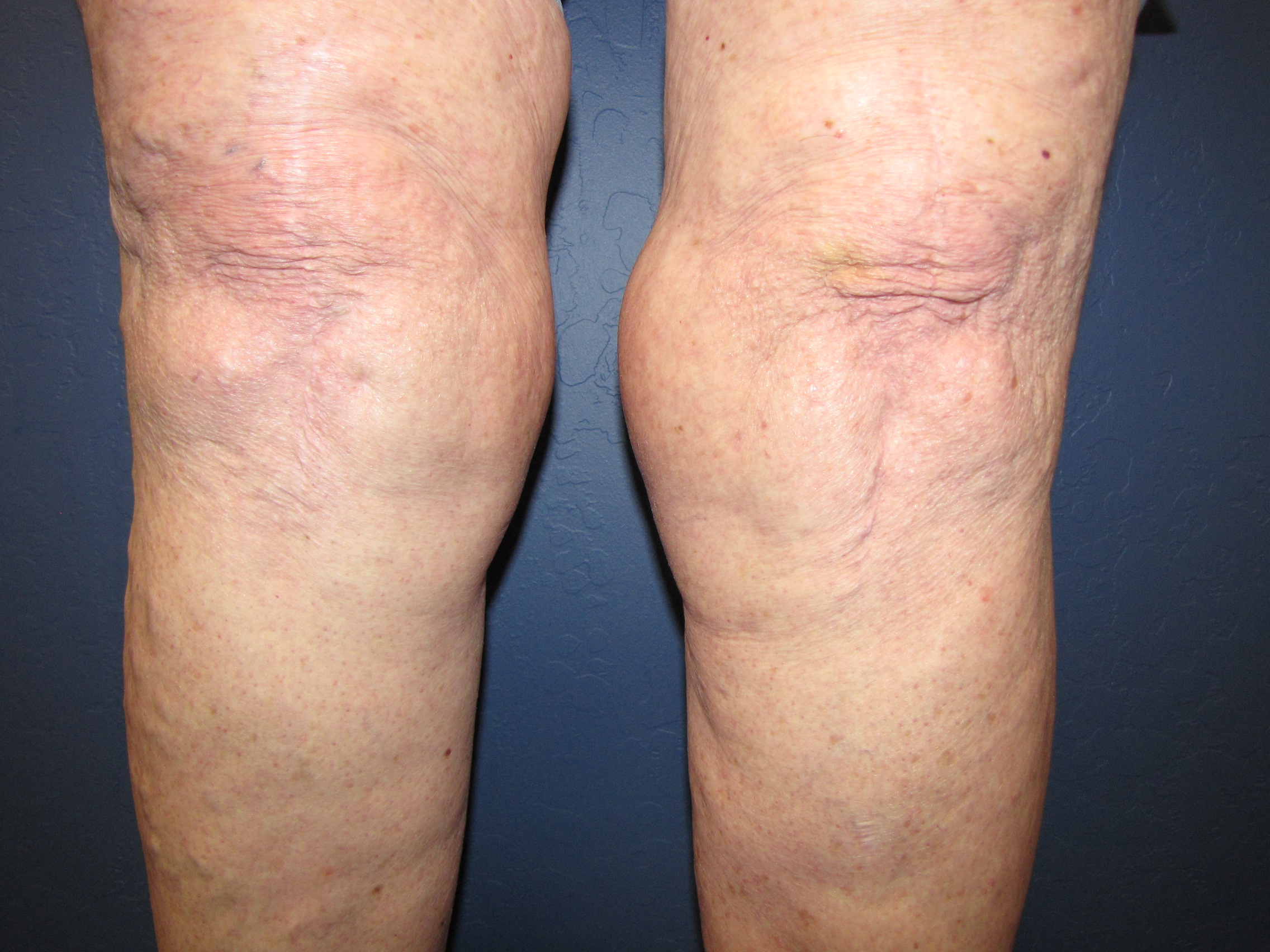 Liposuction-of-knees-pre.jpg