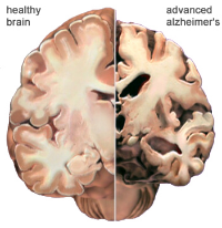 Alzheimer's disease leads to nerve cell death and tissue loss throughout the brain. Over time, the brain shrinks dramatically, affecting nearly all its functions.