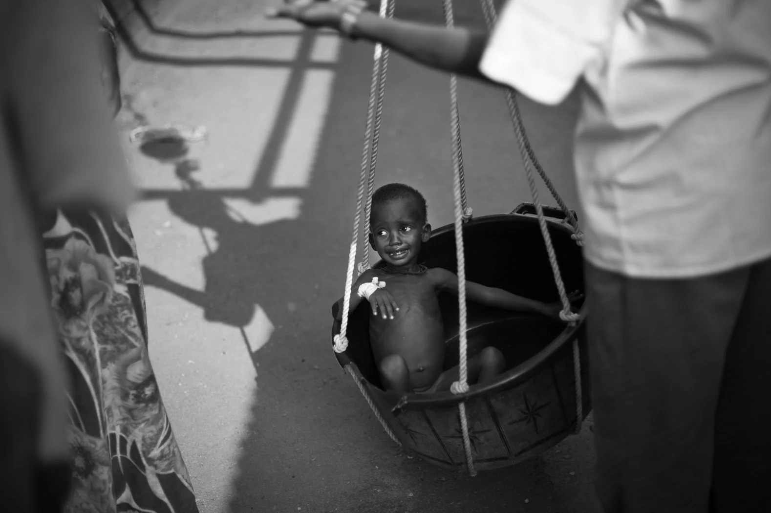 A Somali child suffering from acute malnutrition is weighed at the Médicins Sans Frontières (MSF) hospital in Dagahaley refugee camp. MSF is currently treating over 7000 children for malnutrition in Dagahaley alone.