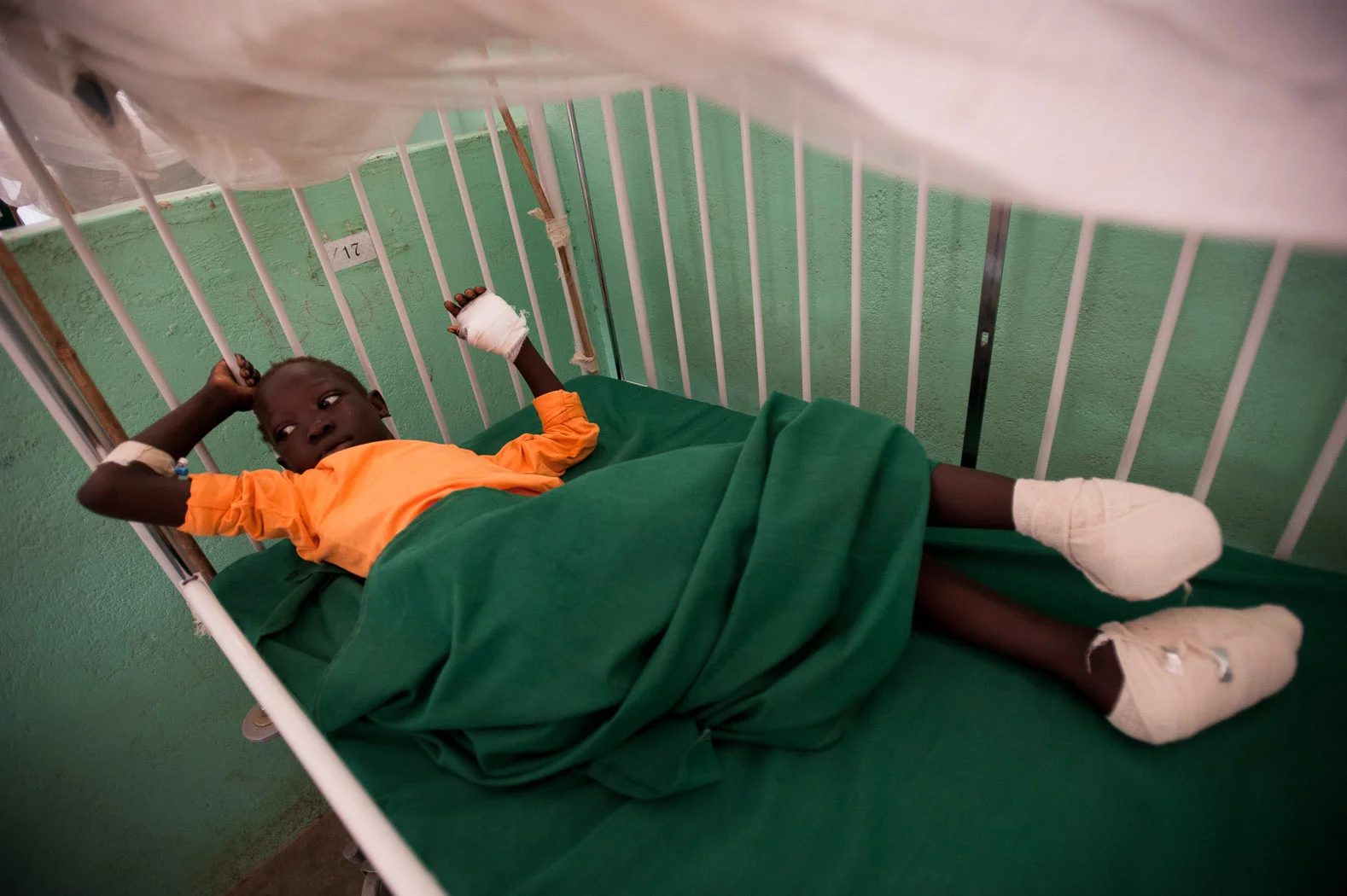 Mursila Timas (10) has had one foot amputated, the other seriously damaged, and has an injured thumb and infection, risking the amputation of her hand. She was hit by shrapnel as a bomb exploded in her village of Kurchi.