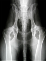 Severe Hip Dysplasia.jpg
