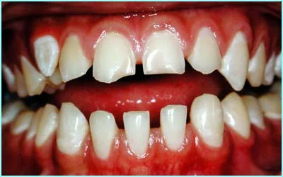 Braces