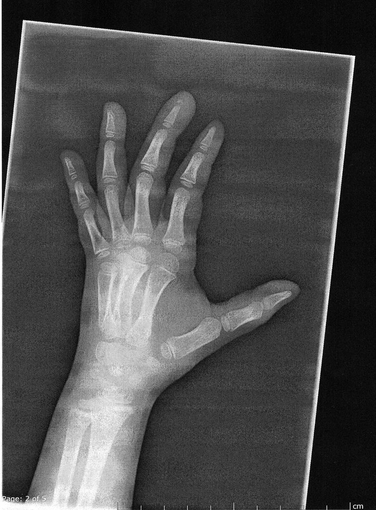 broken-finger.jpg