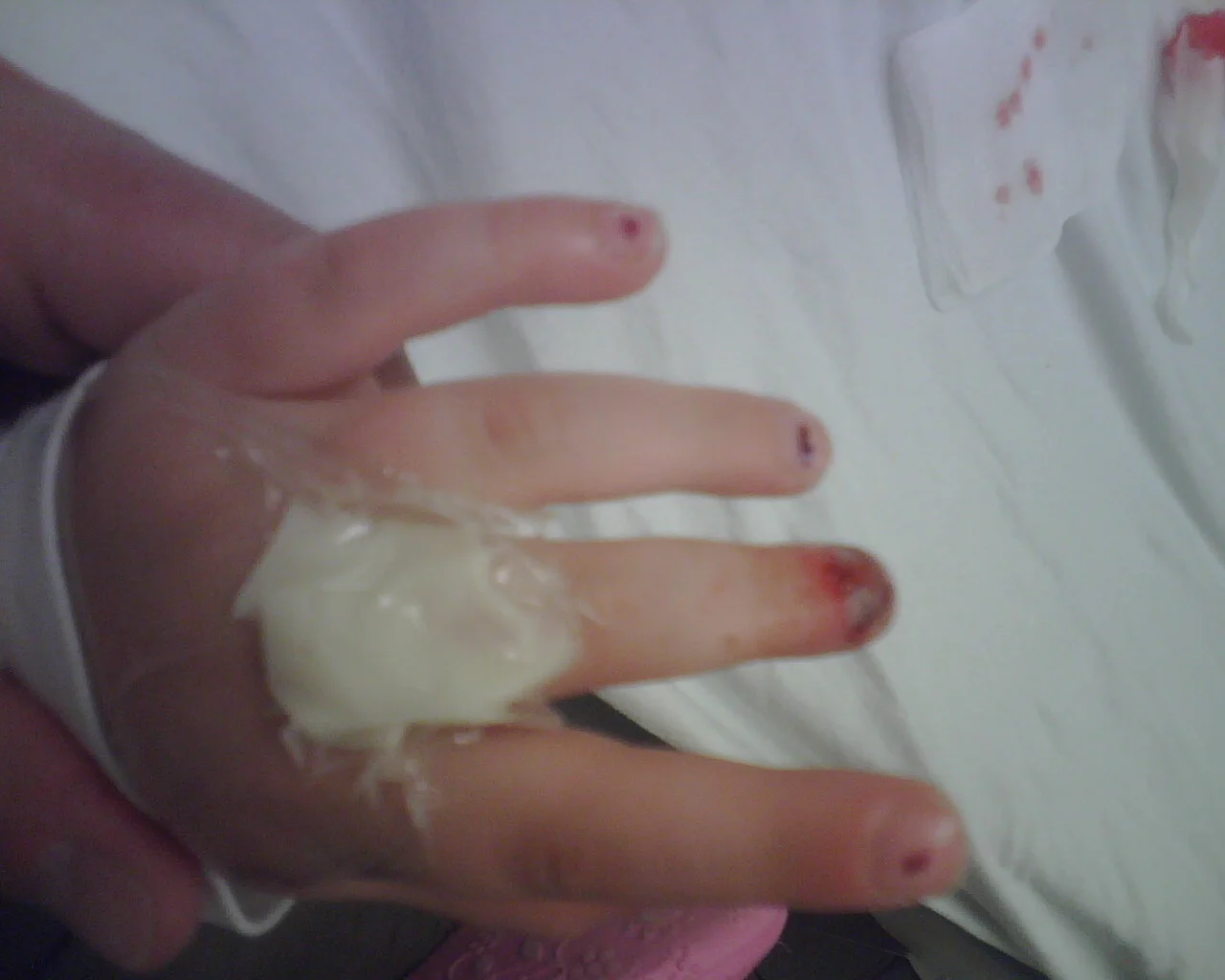 mia-bloody-broken-finger.jpg
