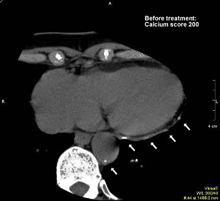 Figure 2.1: The patient is a 69 year-old woman. Her initial coronary calcium score was 200 on the Agatson scale. Large areas of calcified plaque along coronary artery and some in aorta (arrows) are present. Note the marked thickening of the disease affected artery.