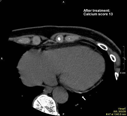 Figure 2.2: In one year coronary artery calcium score of 200 was reduced to 13 (Agatson scoring system). This is a 93.5 percent improvement. Most of the artery (to the right of arrow) is now healed and free of calcium. The arrow points to a small amount of plaque that has not yet resolved.