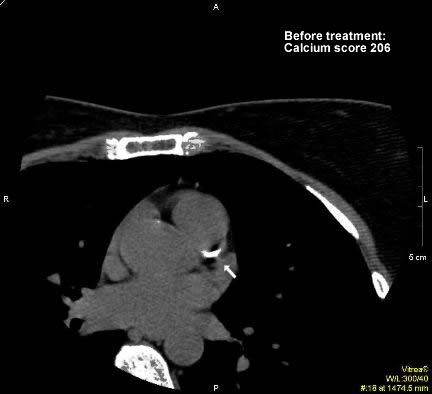 Figure 1.1: Patient is a 59-year-old woman. Initial coronary calcium score was 206 on Agatson scoring system. A large calcified plaque at the origin of coronary arteries (arrow) is present.