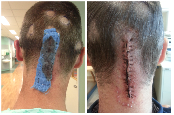 On the left: My Punk dressing, stapled neatly into place. C’est brutal, mais ça marche... On the right: A week later the dressing came off. My medical team is delighted with the quality and rapidity of the healing process. I need to keep an eye out for any weeping of clear fluid, as this could be a sign of infection, which could result in nasty complications…