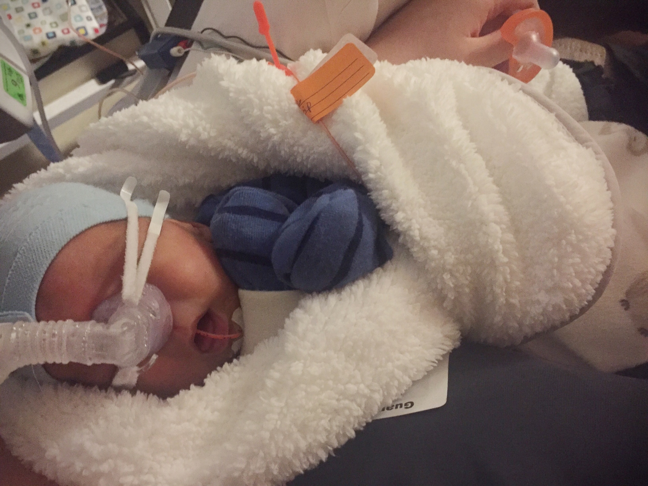 2 months old (Finally on a CPAP and at 26% oxygen!) Weighing 4lbs 5oz today and continuing to thrive.
