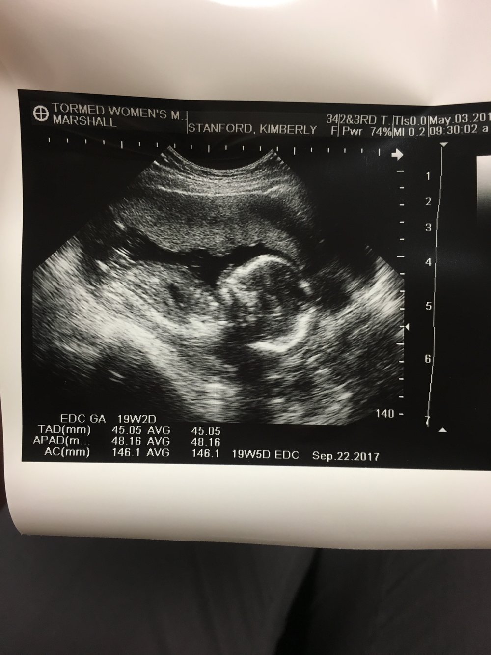 Baby Girl's anatomy scan at 19 weeks 