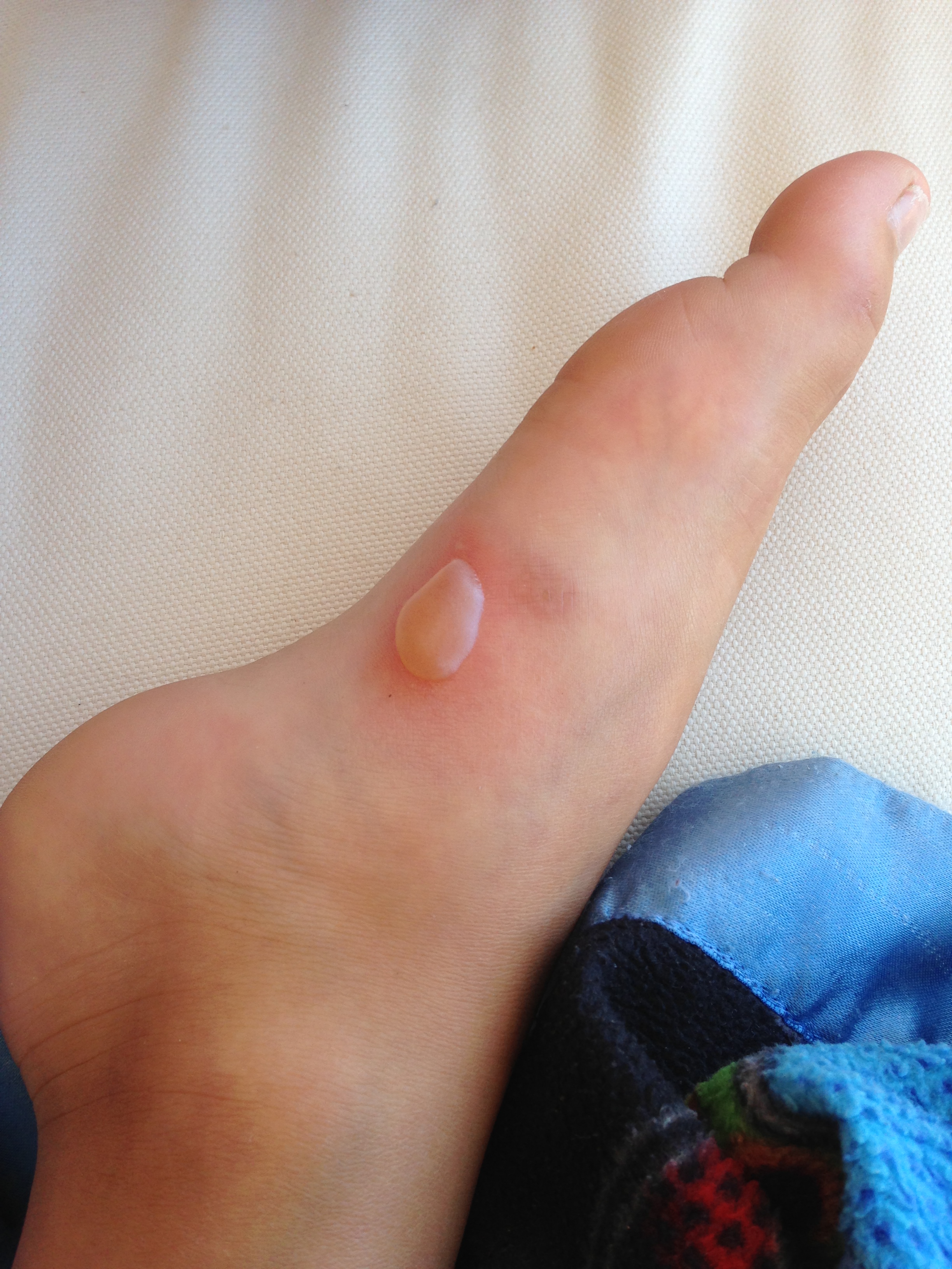 THE blister