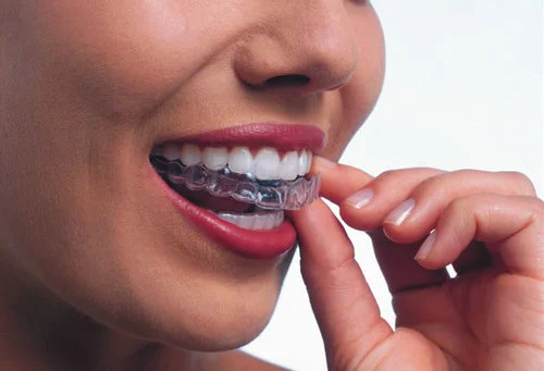 Invisalign: Aligner trays are made of smooth, comfortable, and virtually invisible plastic that you wear over your teeth. 