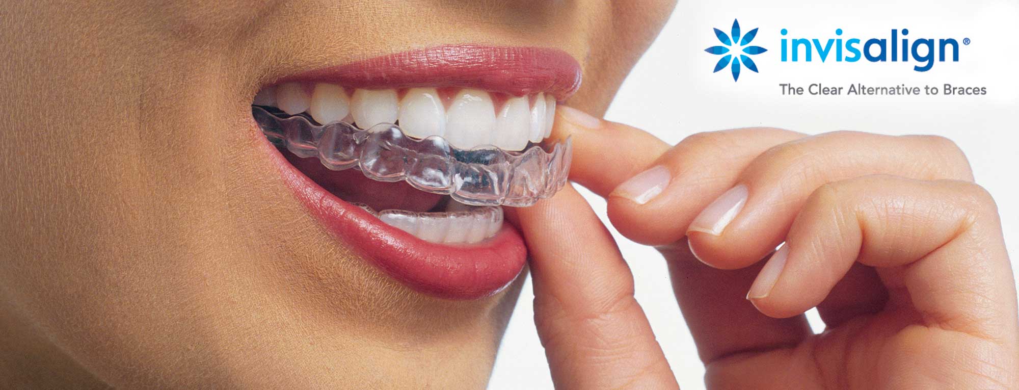 Should I Get Invisalign (Clear Aligners) or Braces?