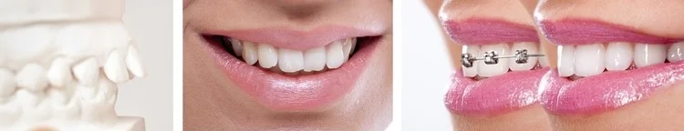 Aligners, Classic Brackets, clear brackets - options to meet your unique needs. Let the office know your request.