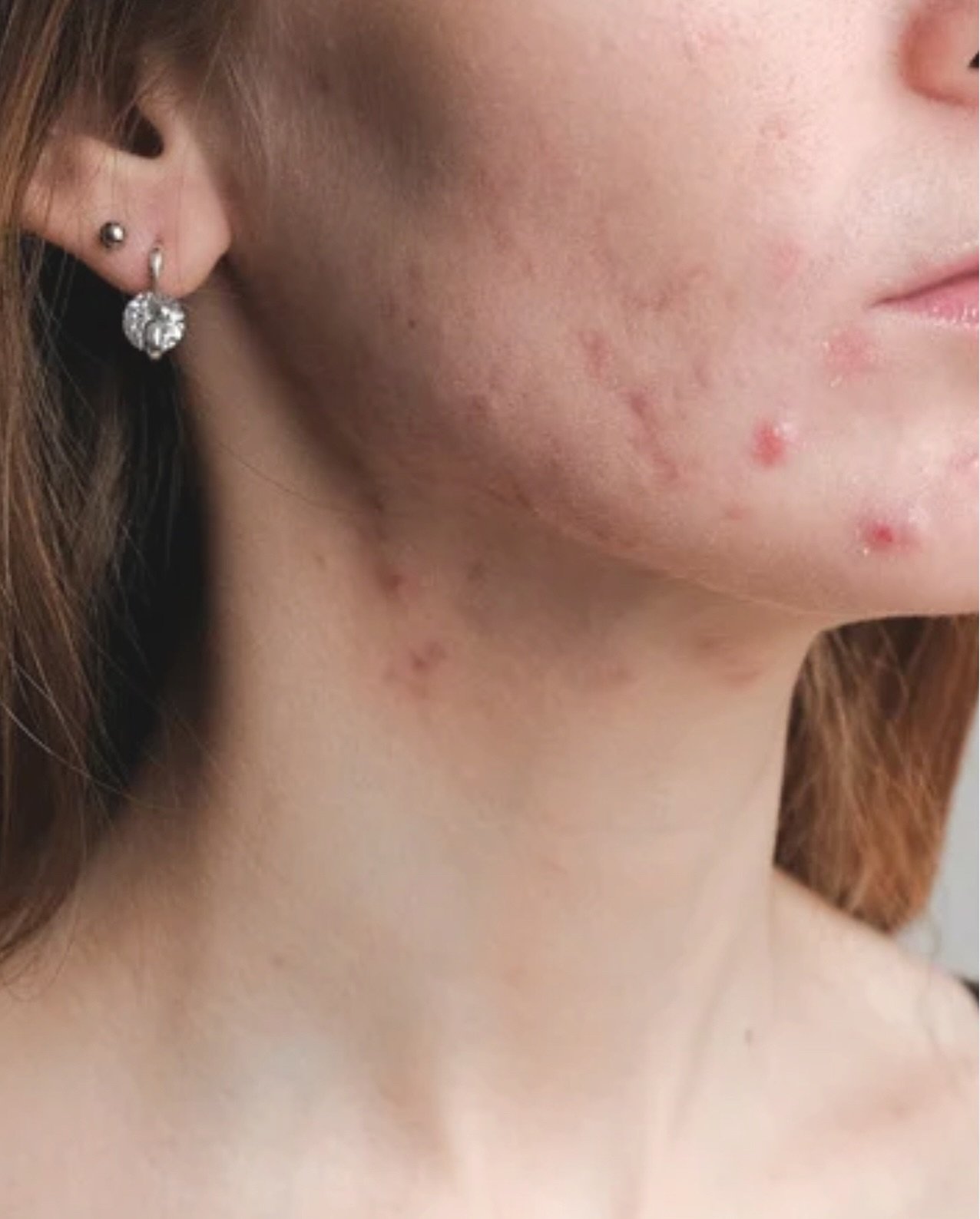 ✨ June is Acne Awareness Month ✨ So let&rsquo;s get one thing clear &mdash; your skin deserves better than outdated advice and skin-deep solutions.

At MizHitch, we don&rsquo;t fall for the usual acne &ldquo;propaganda&rdquo; like:
❌ &ldquo;Just exfo