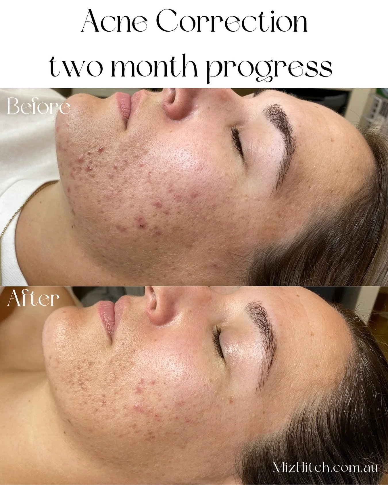 ✨ Before & After Acne Correction ✨
This amazing result is the power of consistency + professional care 💫
Our gorgeous client committed to a simple yet effective at-home routine. Beginning early June the following products began being implement