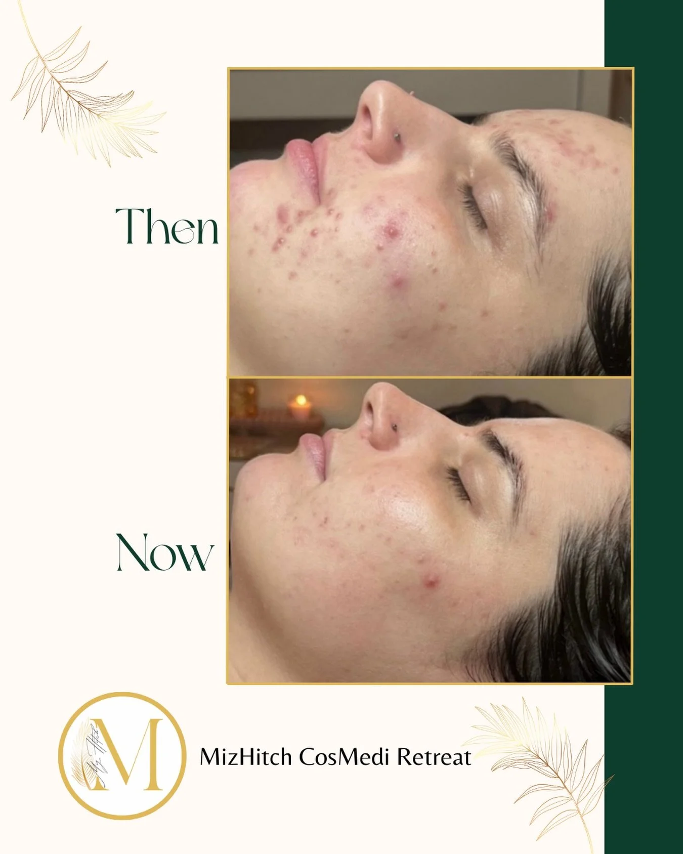 This is what happens when acne is treated with patience, precision, and a plan.

This transformation was achieved through a series of our skin needling treatments, carefully spaced and tailored to support skin repair, reduce active breakouts, and imp