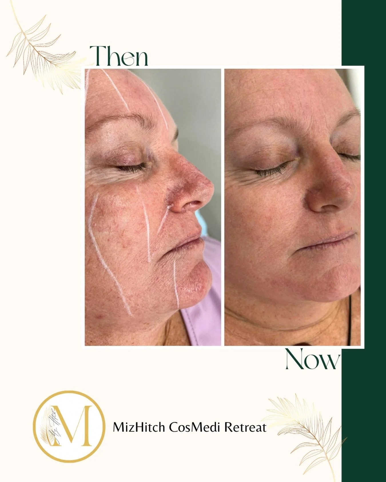 One treatment 💫 Photos taken 2 weeks apart 💫 A visible shift 💫

For someone living with constant redness or visible capillaries&hellip; this isn&rsquo;t just &ldquo;skin.&rdquo;

It&rsquo;s confidence.
It&rsquo;s comfort.
It&rsquo;s finally seeing