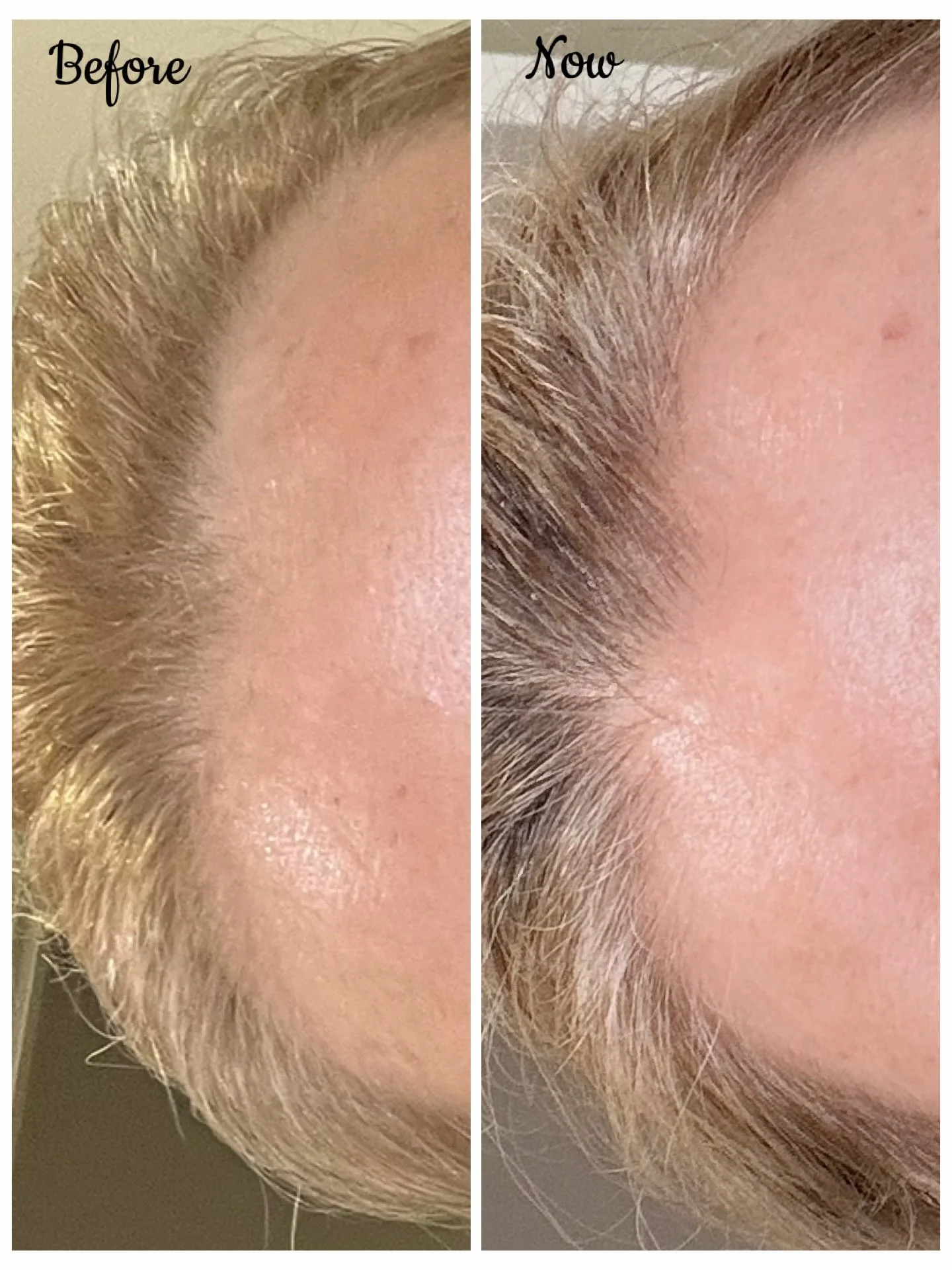 Hair loss or thinning got you down? Come cry to us about it! Because thinning hair doesn&rsquo;t have to be something you simply accept.

Tried, tested and results-driven hair restoration solutions are available right here at MizHitch 💫

Recognise t