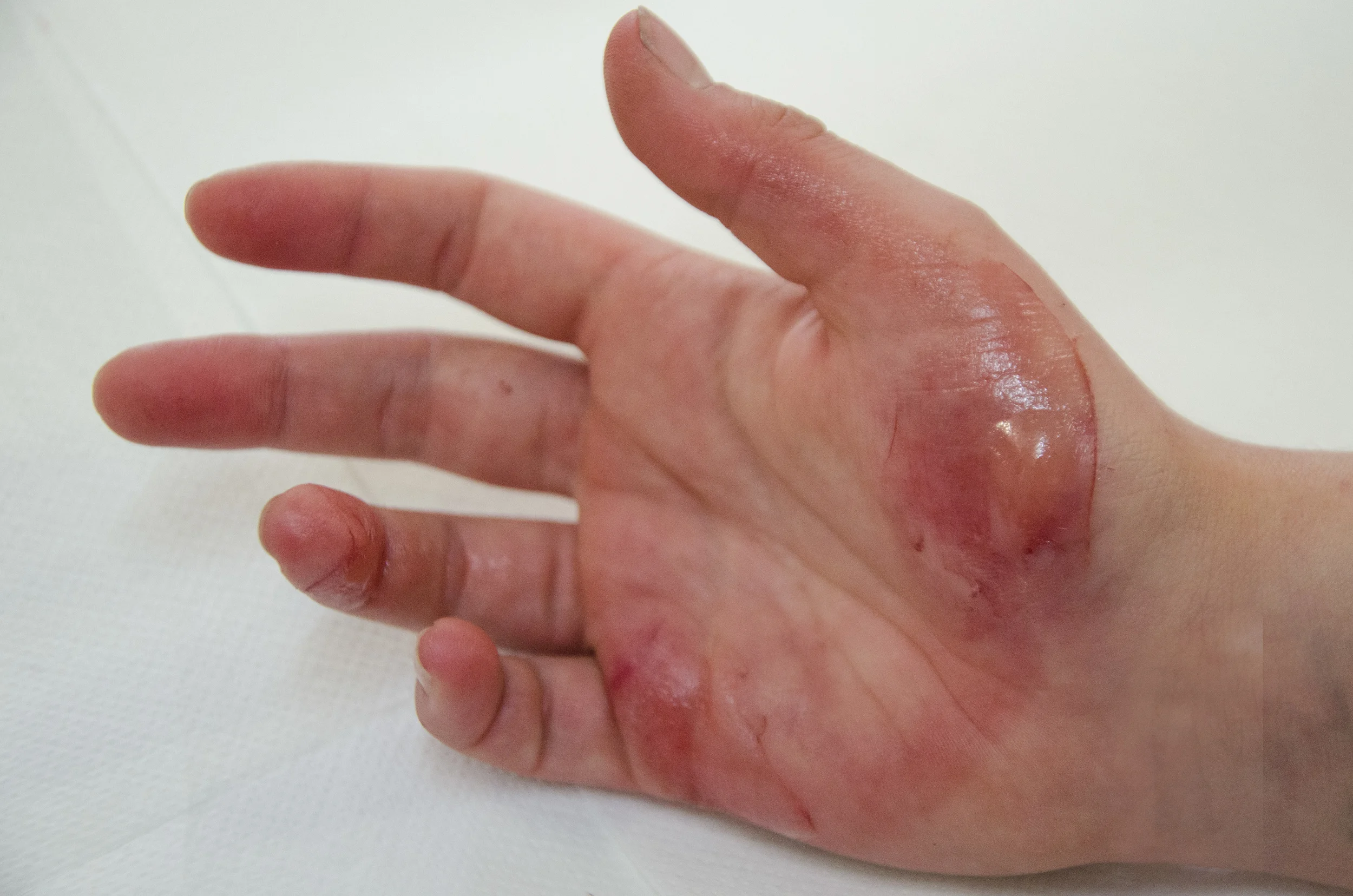 Verbrennung Herdplatte