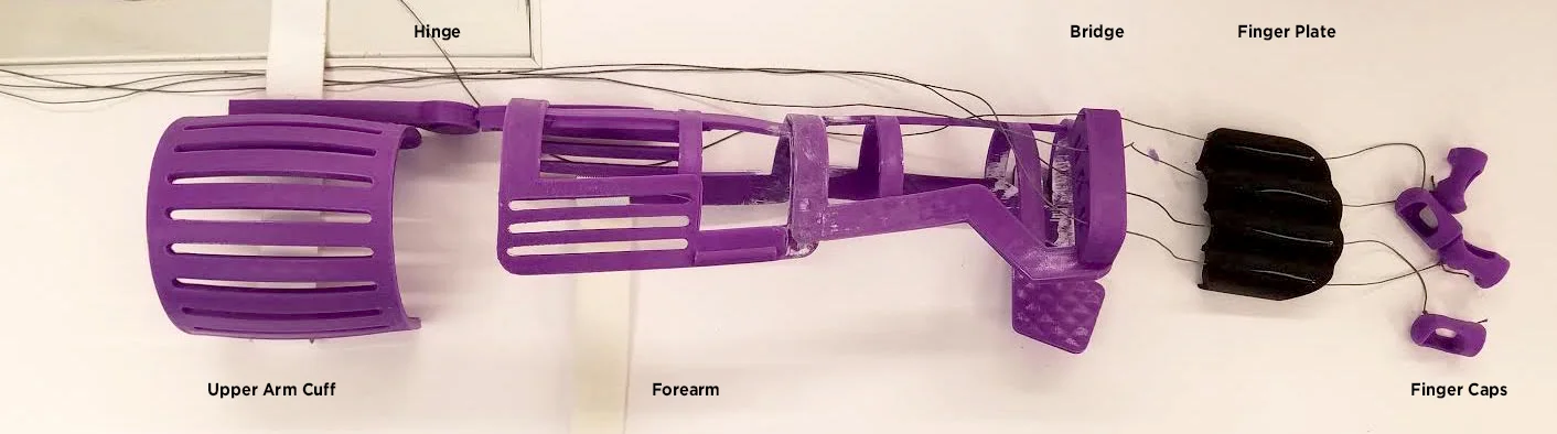 A modified Airy Arm orthotic