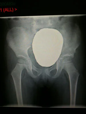 The image of Zoe's hip prior to the wires being removed.