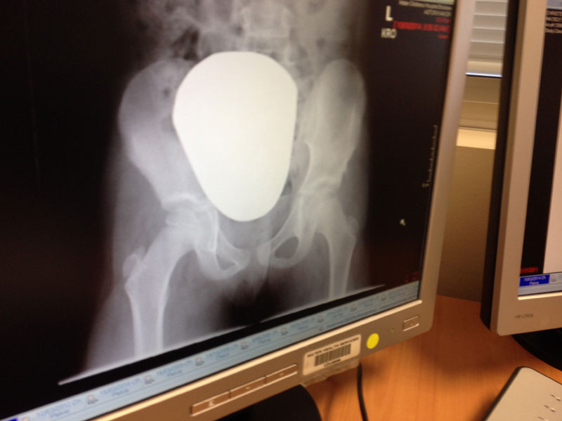 This is Zoe's latest x-ray. The surgeon was very happy with how her hips are growing and he expects her to continue to make a complete recovery. Her next check up is when she turns ten, June 2016.