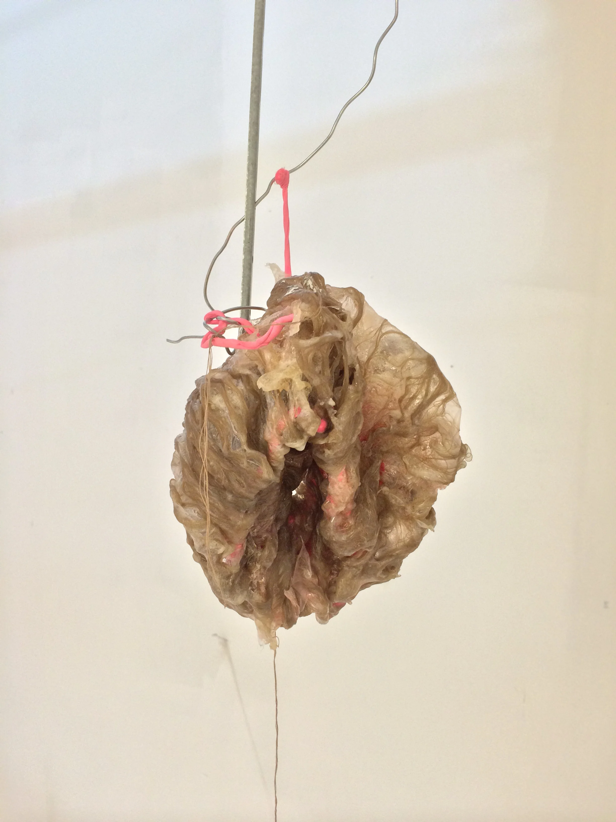 Retroperitoneal (5).JPG