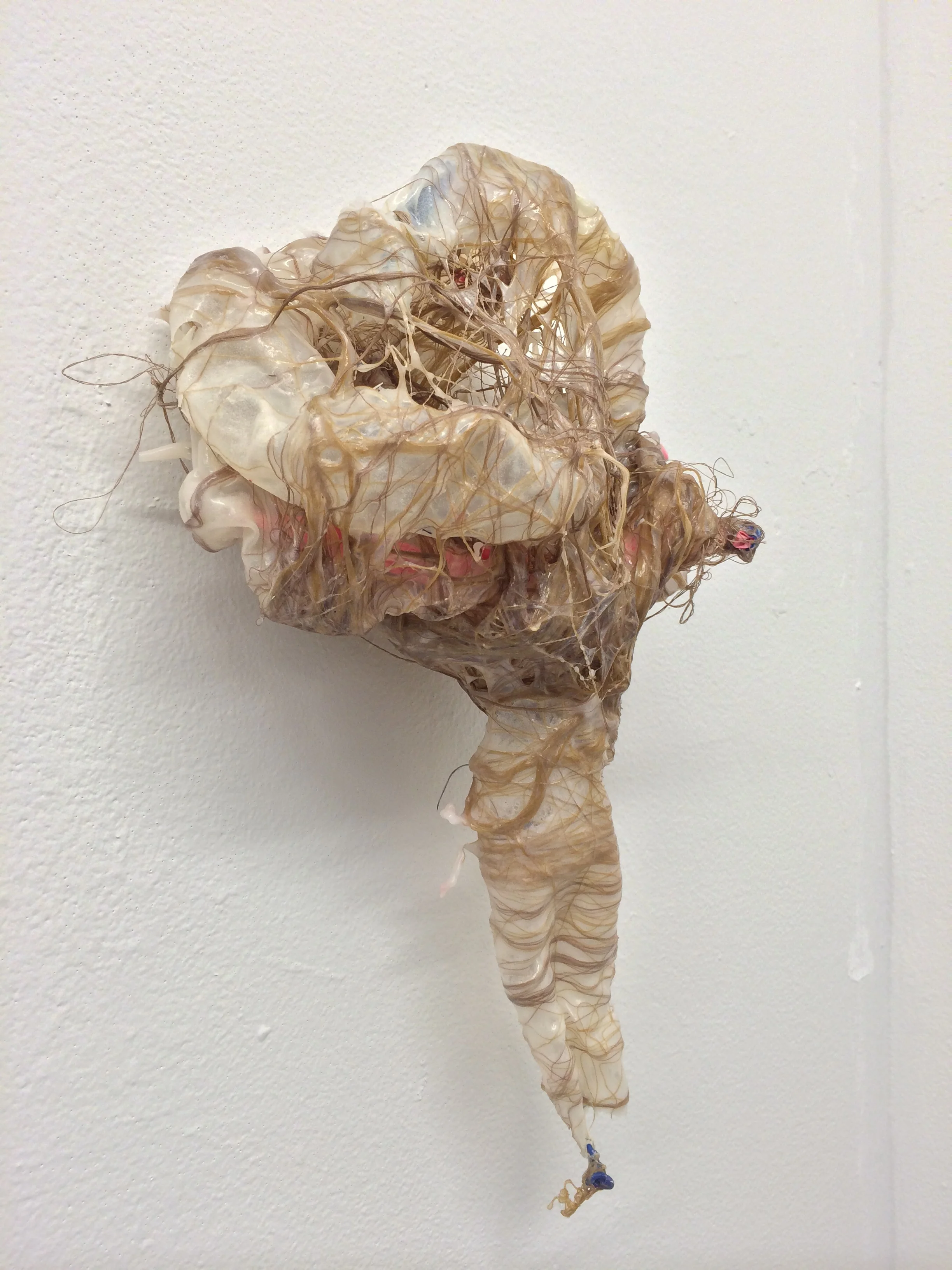 Retroperitoneal 5 (2).JPG