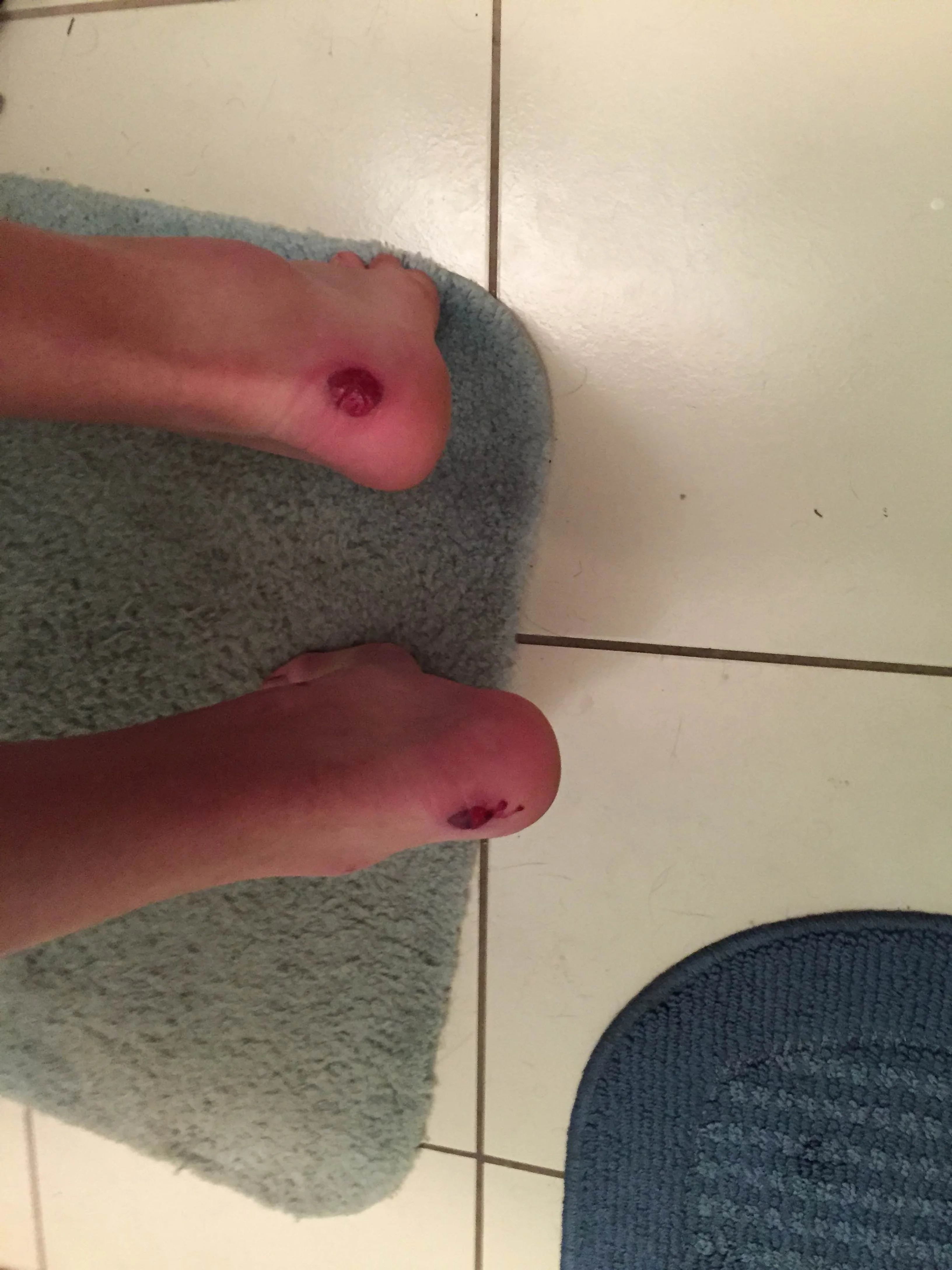 What eventually became of my heels after the event. Yes it bled out a lot. Shoes hurt.