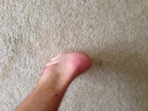Slightly red, which is normal. No hotspotting or any pain.