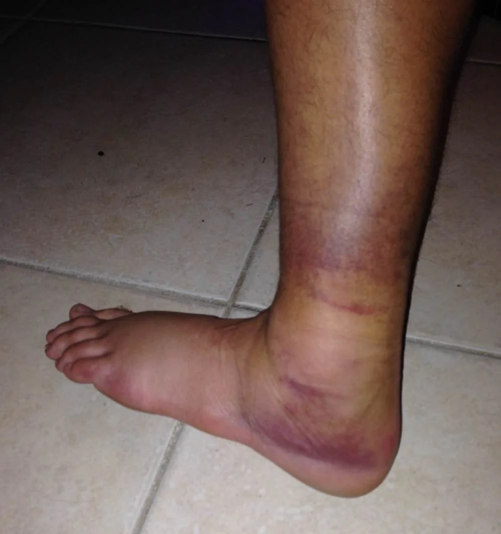 My (k)ankle, a day later in 2013. Watch your footing, ok? I tore it up just as bad at the 2019 death race, too :(