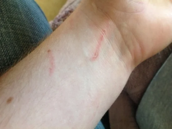 Scratches left by Professor Young on Thrin's left arm.