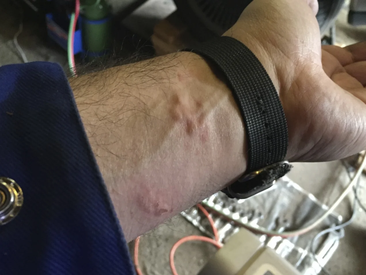 Mild burns caused by a piece of hot metal dropping down my level while grinding.